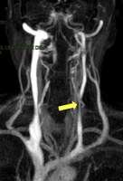 Diagnosi e trattamento dell'Insufficienza Venosa Cronica Cerebrospinale (CCSVI)