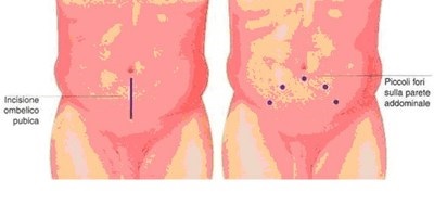 laparoscopia.jpg laparoscopia.jpg