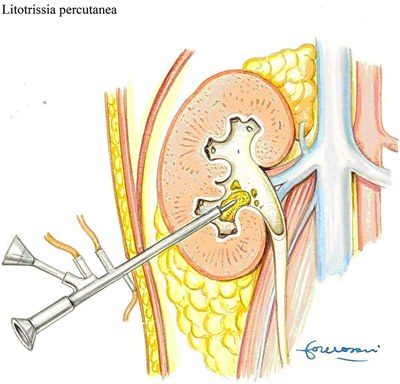 litotrissia-percutanea.jpg litotrissia-percutanea.jpg